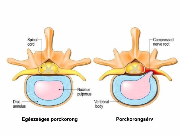 Normal porc vs hernia